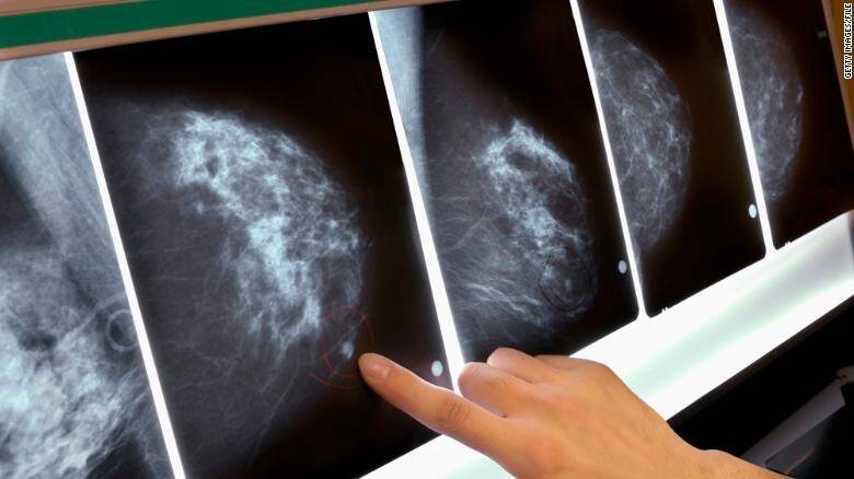 111018092923-mammogram-breast-cancer-x-ray-exlarge-169.jpg