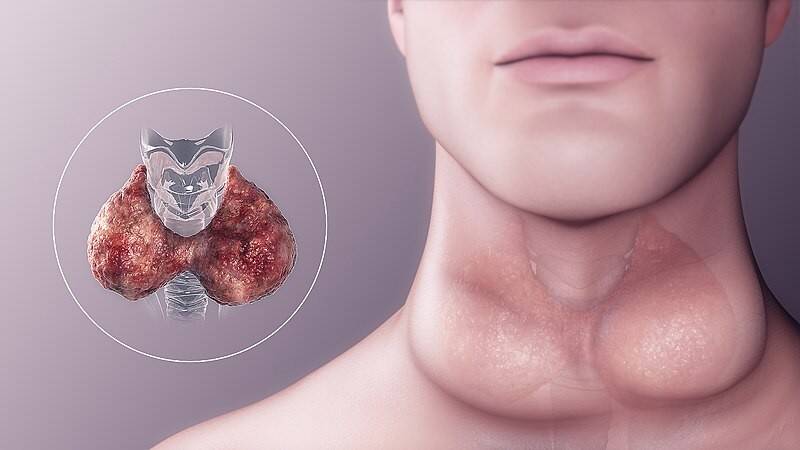 800px-Hypothyroidism.jpg