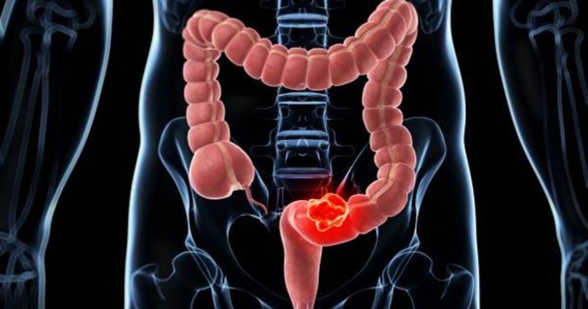 cancer-colon-sintomas-kMaG-1200x630@abc.jpg