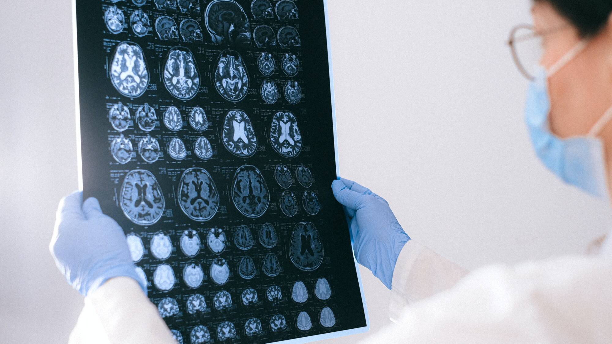 CHILENOS-ALZHEIMER-DEF.jpg