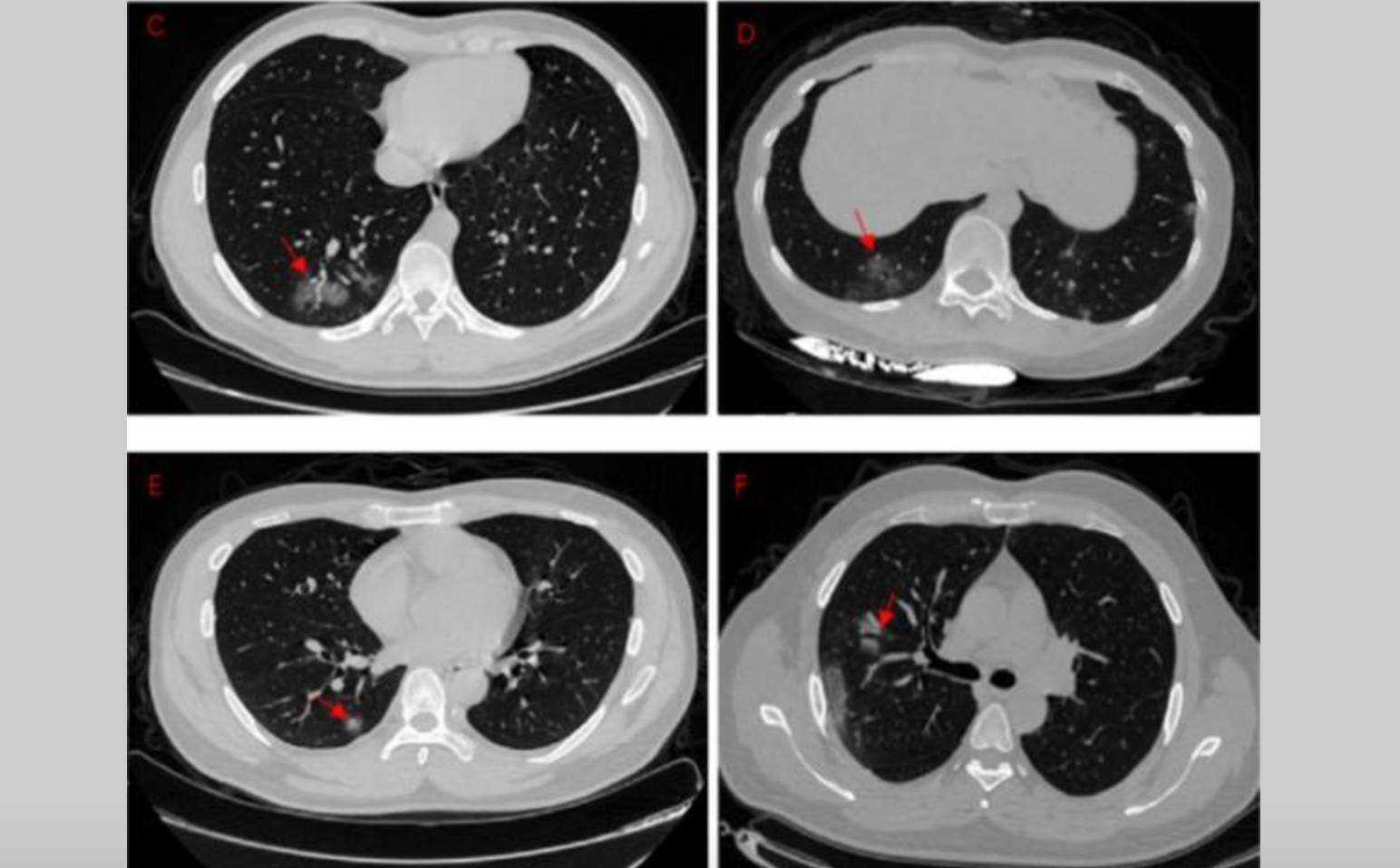 daño-pulmones-pacientes-asintomáticos-COVID-19.jpg