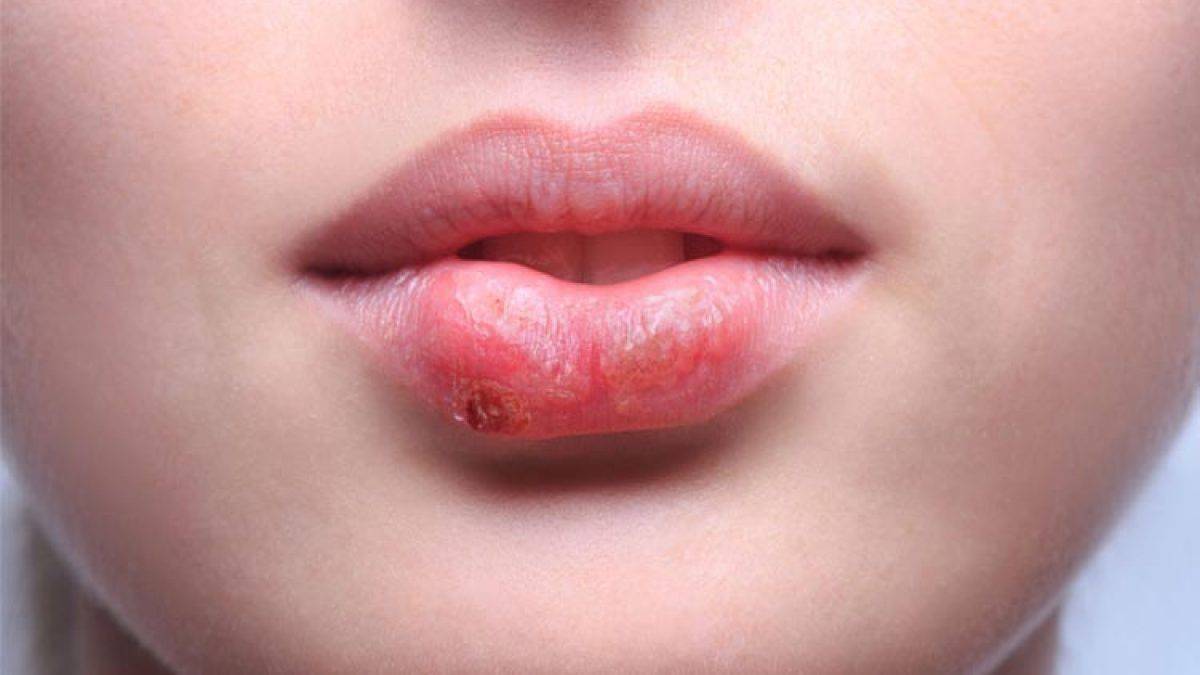 herpes-labial.jpg