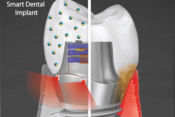 smart-dental-implant-600x400.jpeg