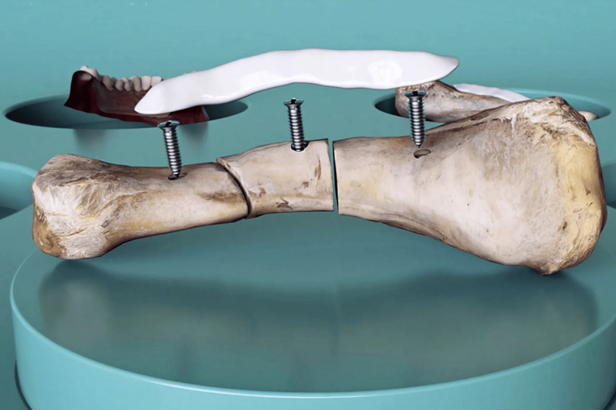 Ilustración 3D de un hueso largo fracturado fijado con tornillos quirúrgicos y una placa blanca de osteosíntesis.