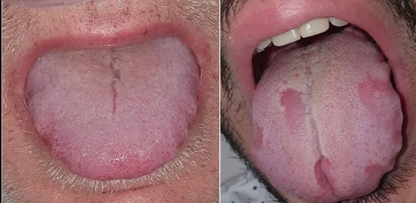 Dos imágenes comparativas de una lengua que muestra evolución de lesiones: izquierda con capa blanquecina uniforme y derecha con manchas rojizas irregulares.