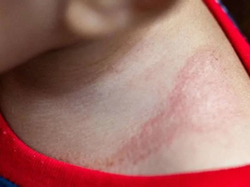 Cuello de un niño con una marca rojiza lineal visible sobre la piel, posiblemente causada por fricción o rozadura.