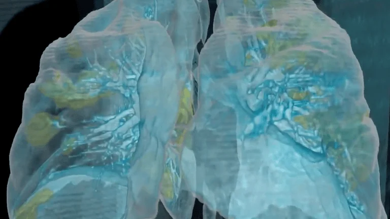 Reconstrucción tridimensional de pulmones humanos que muestra áreas dañadas resaltadas en amarillo sobre tejido pulmonar azulado.
