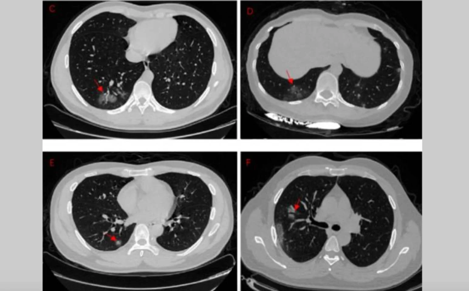 Cuatro cortes de tomografía computarizada de tórax (C, D, E, F) con flechas rojas señalando lesiones en pulmones.