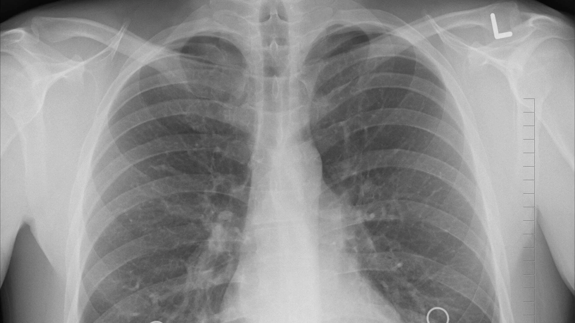 Radiografía frontal de tórax que muestra ambos pulmones, costillas y estructuras del mediastino en escala de grises.