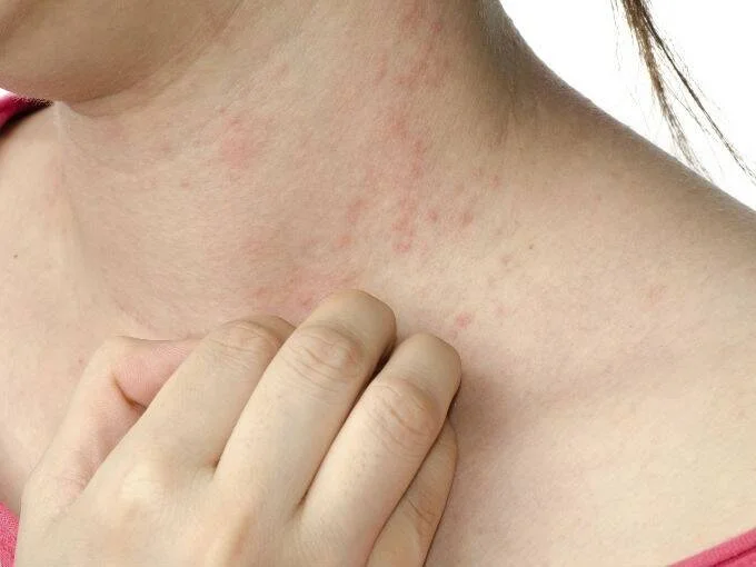 Persona rascándose el cuello y el pecho donde se observa una erupción cutánea con manchas rojas.