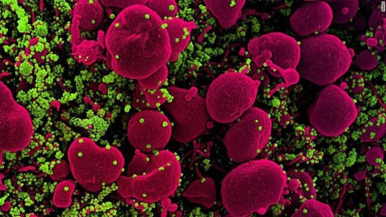 Micrografía electrónica de barrido coloreada muestra células (magenta) repletas de partículas virales (verde) en su superficie.