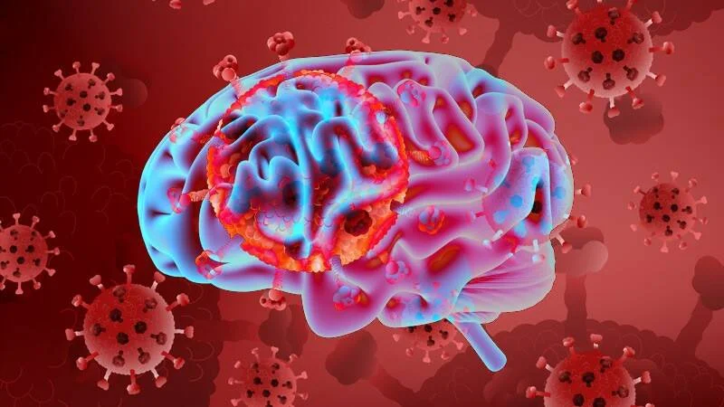 Representación digital de un cerebro humano con zonas inflamadas rodeado de partículas de virus, simbolizando el impacto neurológico de una infección viral.
