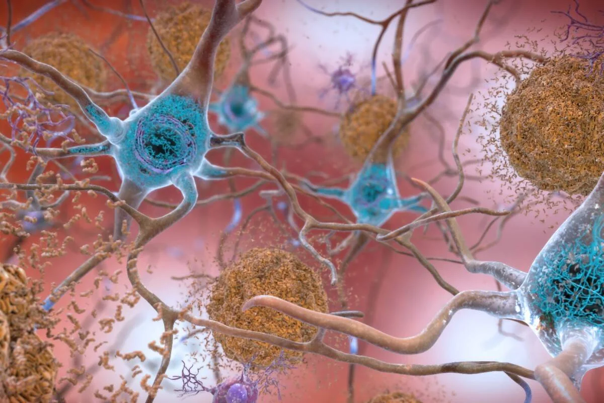 Representación tridimensional de neuronas cerebrales rodeadas de placas de beta-amiloide, asociadas al Alzheimer.