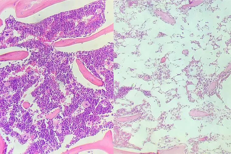 Dos muestras histológicas de médula ósea teñidas con hematoxilina-eosina: izquierda con celularidad normal densa y derecha con hipoplasia marcada.