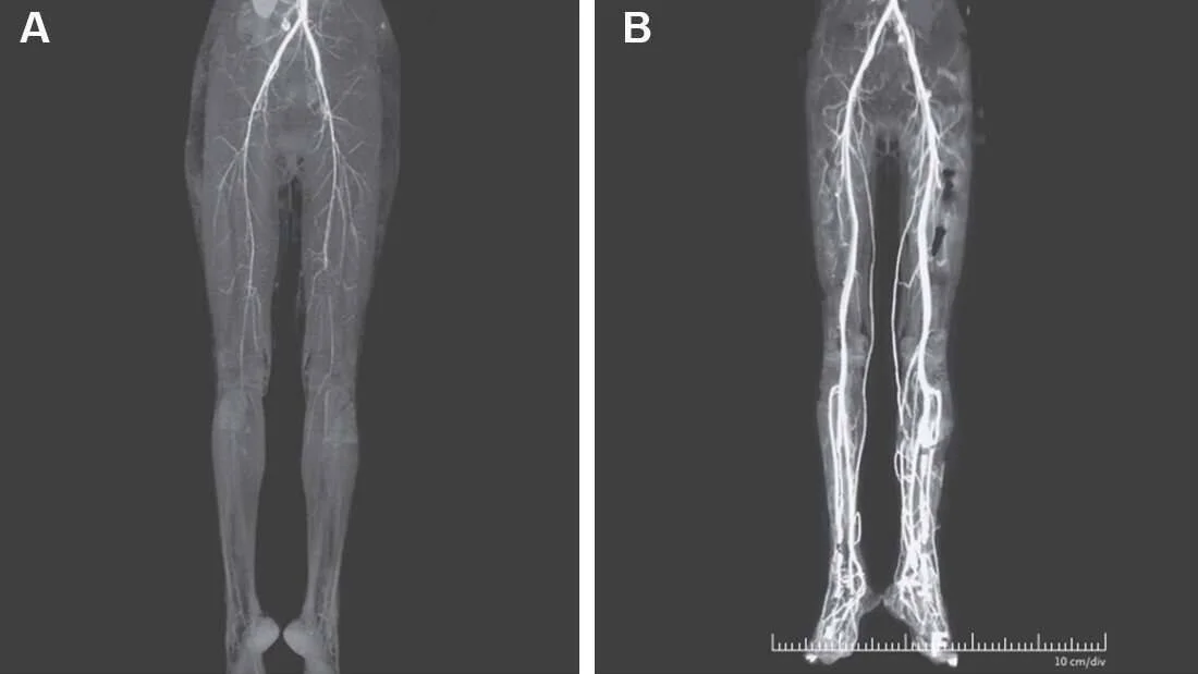 Comparación de angiografías de piernas: imagen A muestra escasa vascularización e imagen B muestra notable recuperación del flujo arterial.