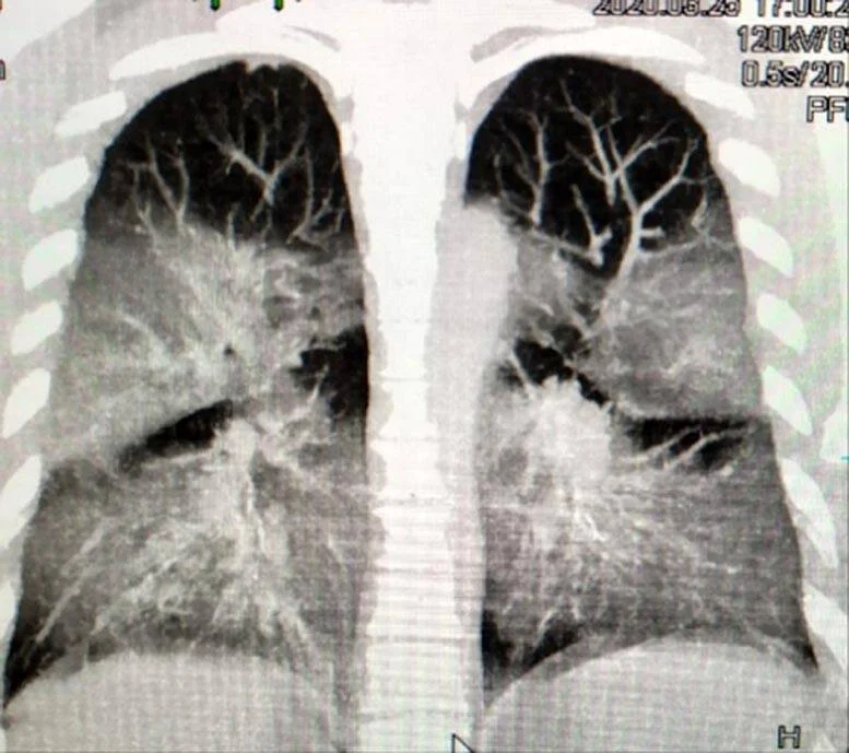 TC de tórax que muestra ambos pulmones con opacidades e infiltrados bilaterales en zonas inferiores, compatibles con neumonía.
