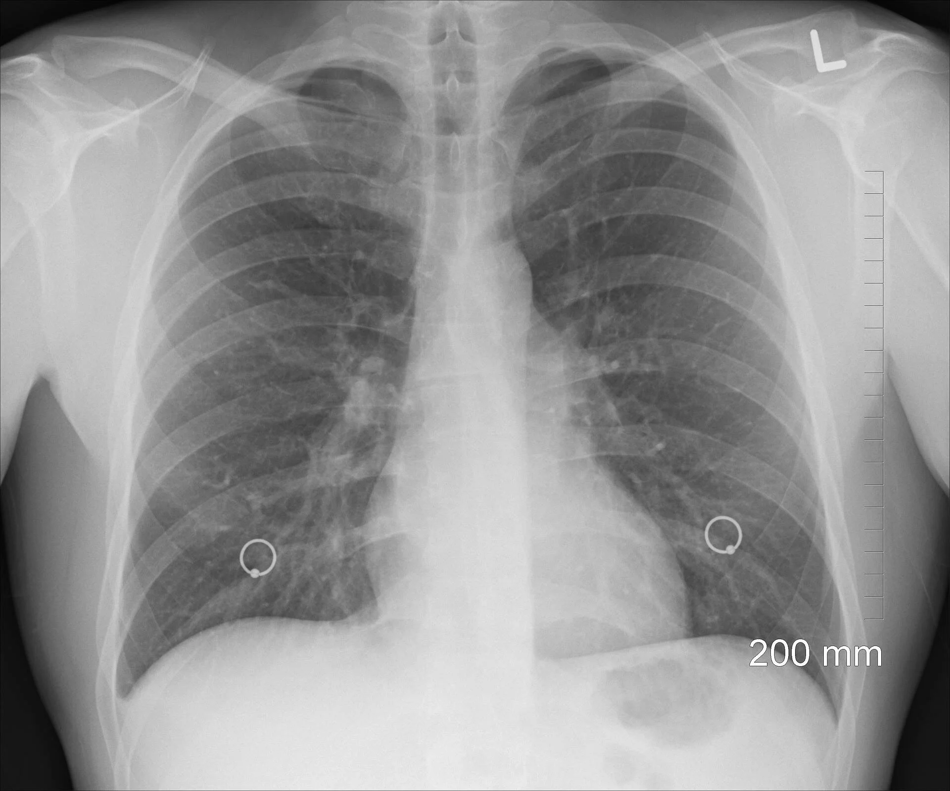 Radiografía de tórax en proyección posteroanterior que muestra ambos campos pulmonares con marcadores circulares metálicos en lóbulos inferiores.