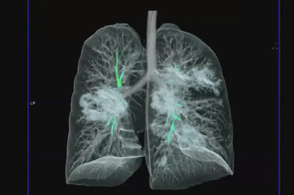 Reconstrucción 3D de pulmones en tomografía computada que muestra zonas de consolidación pulmonar resaltadas con marcadores verdes.