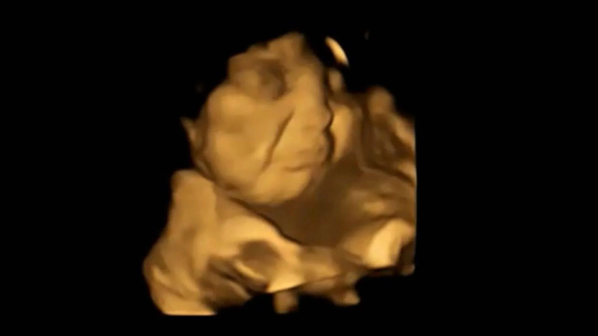 Imagen de ecografía 4D que muestra el rostro y cuerpo de un feto dentro del útero.