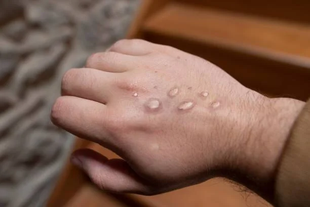 Dorso de una mano con múltiples ampollas o pústulas características de una infección cutánea.