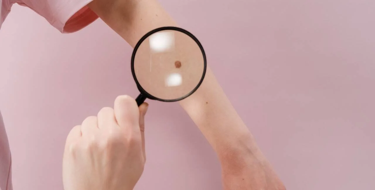 Una persona usa una lupa para examinar de cerca un lunar en su antebrazo.