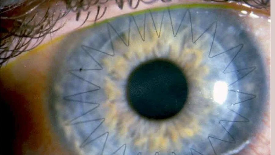 Primer plano de un ojo humano con puntos de sutura quirúrgicos visibles alrededor de la córnea tras un trasplante.