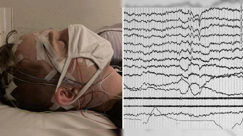 Persona durmiendo con electrodos de EEG sujetos a la cabeza, junto a un gráfico de ondas cerebrales registradas durante el sueño.