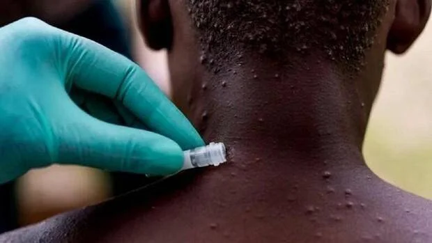 Profesional de salud con guante examina lesiones en la piel de un paciente con mpox en cuello y espalda.
