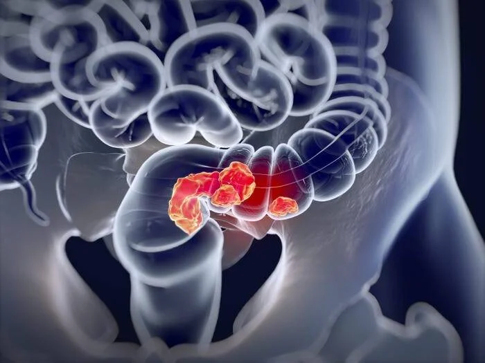 Representación digital del abdomen humano con un tumor resaltado en rojo en el intestino grueso, indicando cáncer colorrectal.