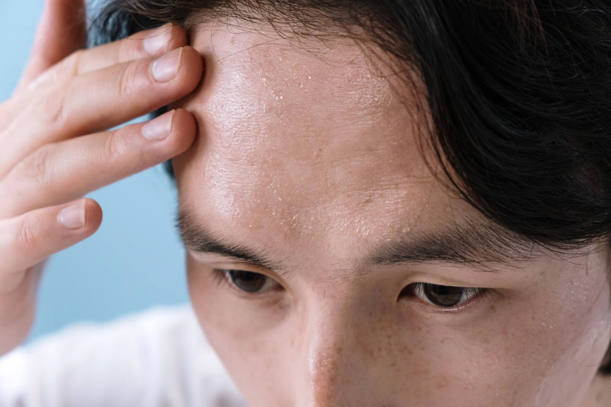 Hombre joven examina su frente con escamas y piel seca visibles, posible dermatitis seborreica o psoriasis.