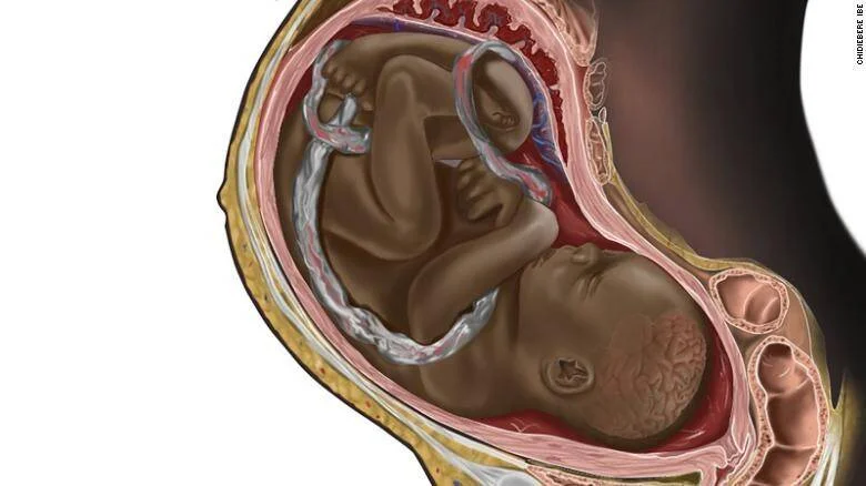 Ilustración anatómica que muestra un feto a término dentro del útero, con piel de tono oscuro y cordón umbilical visible.