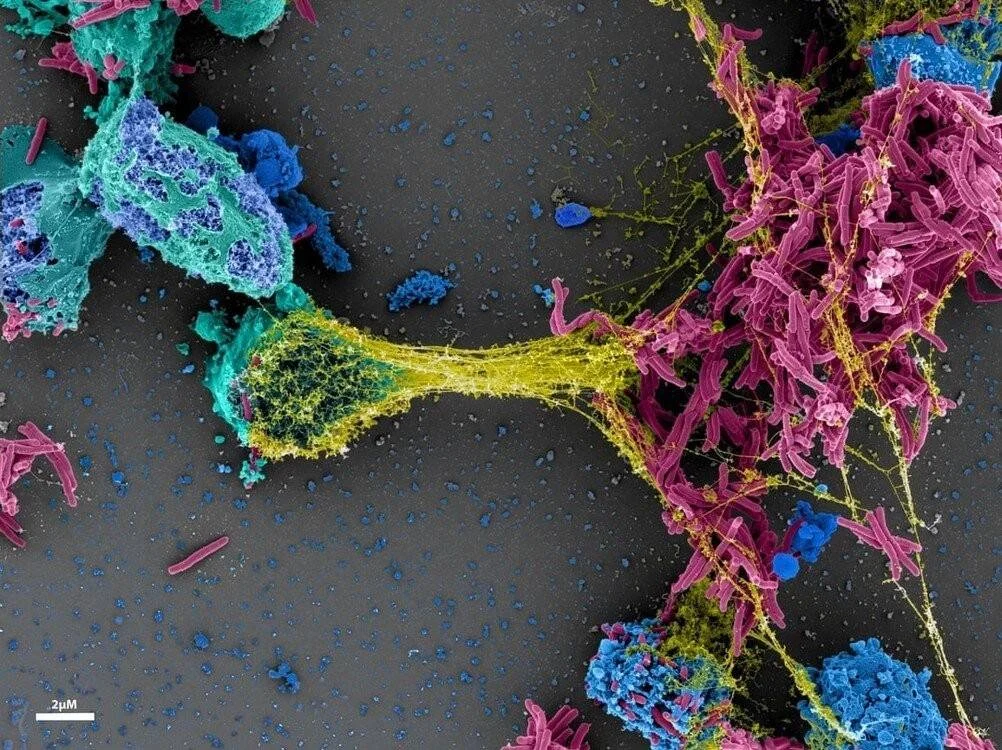 Micrografía electrónica de barrido con falso color muestra células y bacterias en amarillo, rosa, verde y azul a escala de 2 micrómetros.