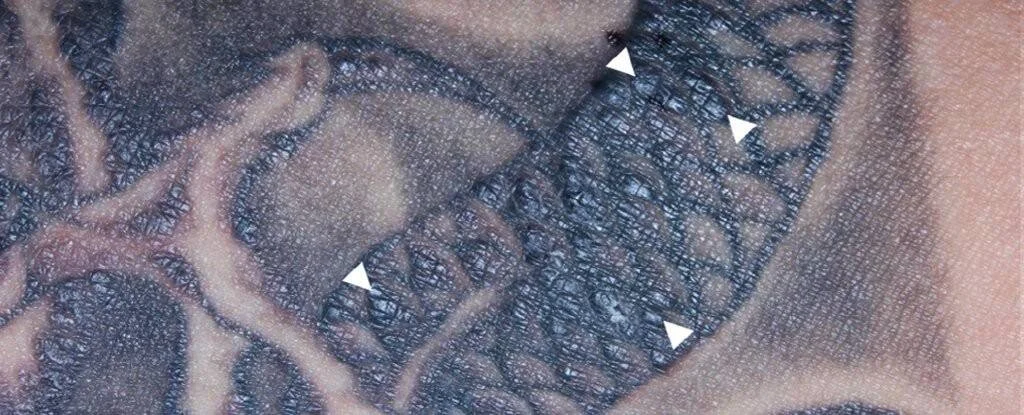 Primer plano de piel tatuada con tinta negra mostrando nódulos granulomatosos señalados con flechas blancas.