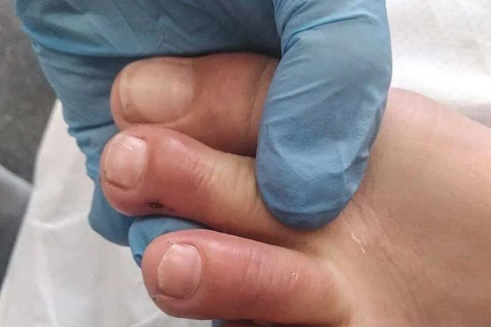 Mano enguantada de profesional sanitario examinando dedos del pie con lesión visible entre ellos.