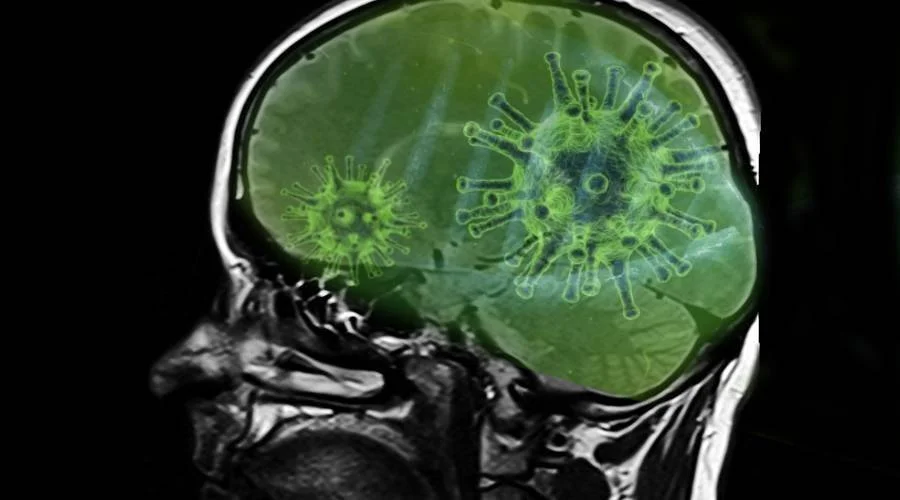 Resonancia magnética de un cerebro humano con ilustración de partículas virales verdes superpuestas, representando infección cerebral.