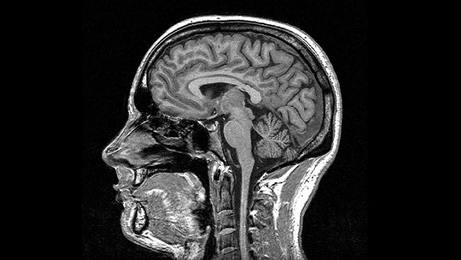 Imagen de resonancia magnética en escala de grises que muestra un corte sagital del cerebro y la médula espinal humanos.