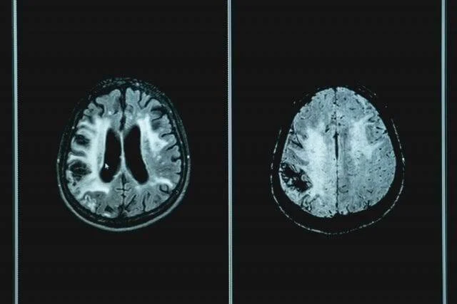Comparación de dos imágenes de resonancia magnética cerebral en corte axial mostrando estructuras del encéfalo.