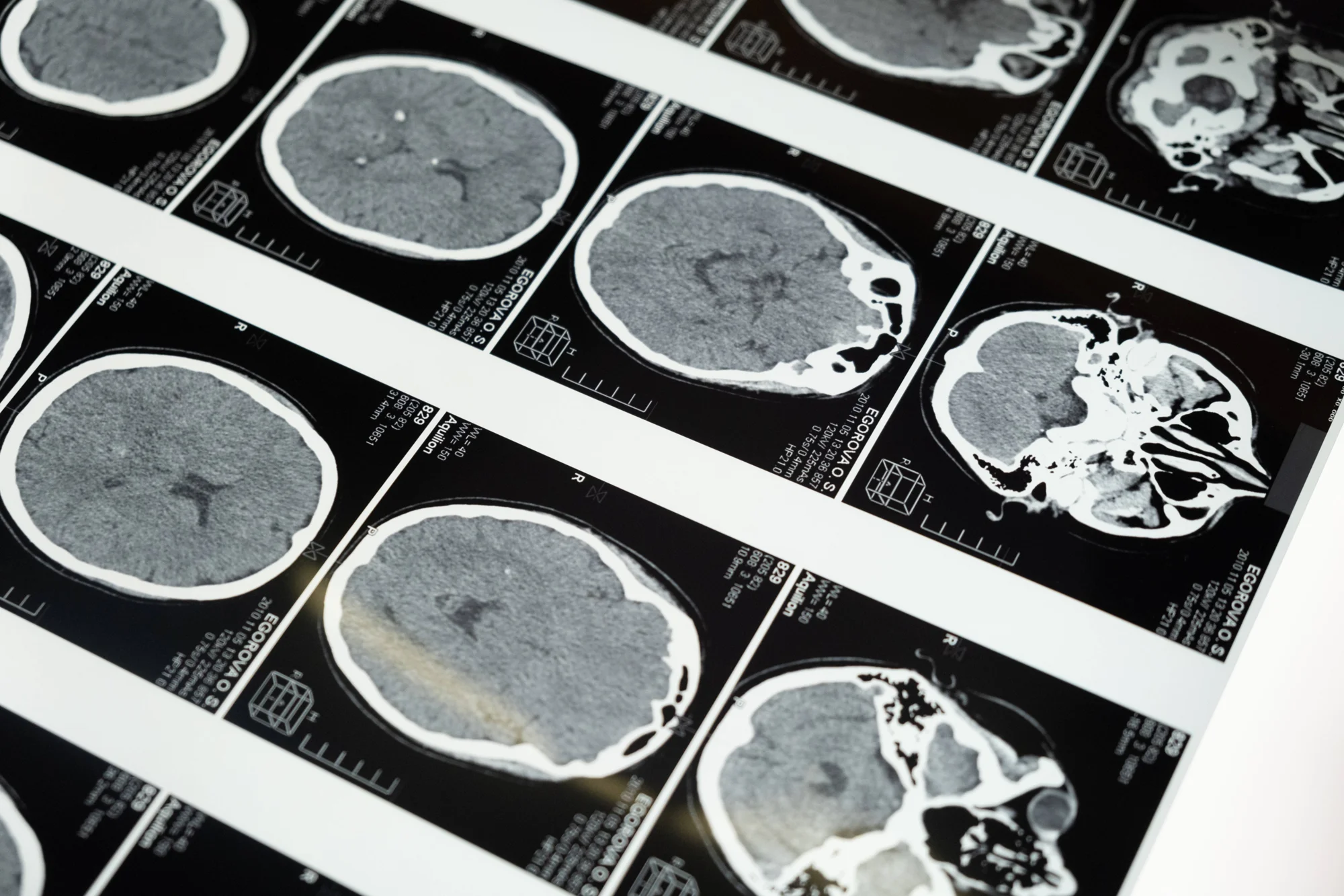 Serie de cortes de tomografía computarizada de cráneo mostrando distintas secciones del cerebro con posibles lesiones.