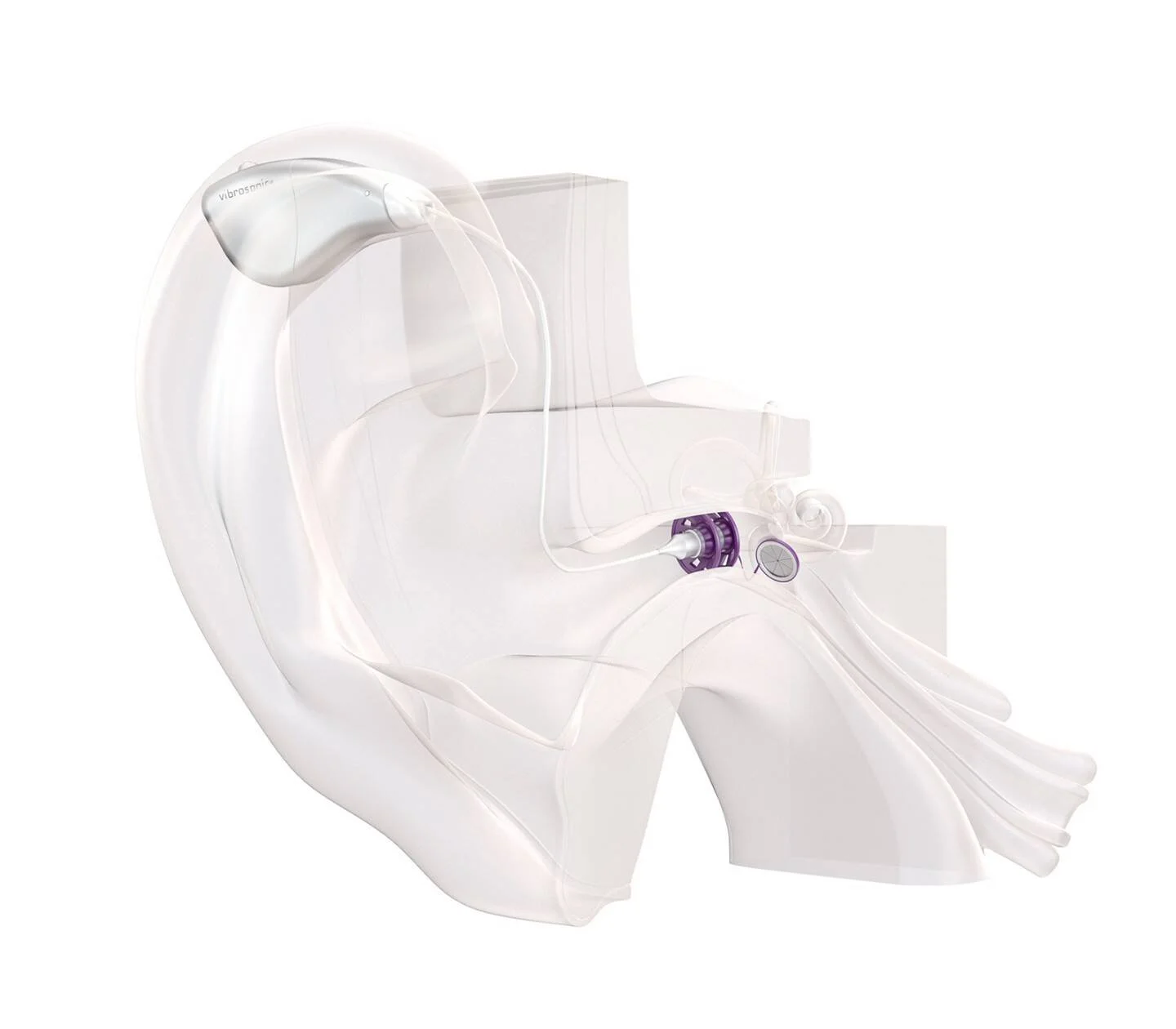 Representación en corte del oído interno mostrando un implante coclear con sus componentes en blanco y violeta.