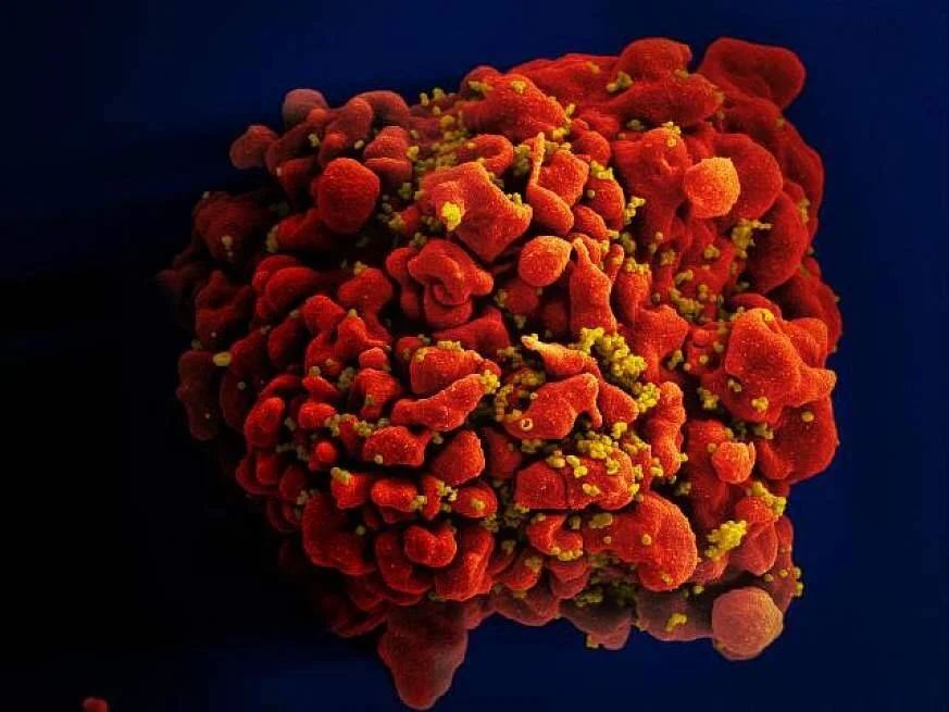 Micrografía electrónica coloreada de una célula T (roja) infectada con partículas del virus VIH (amarillas).