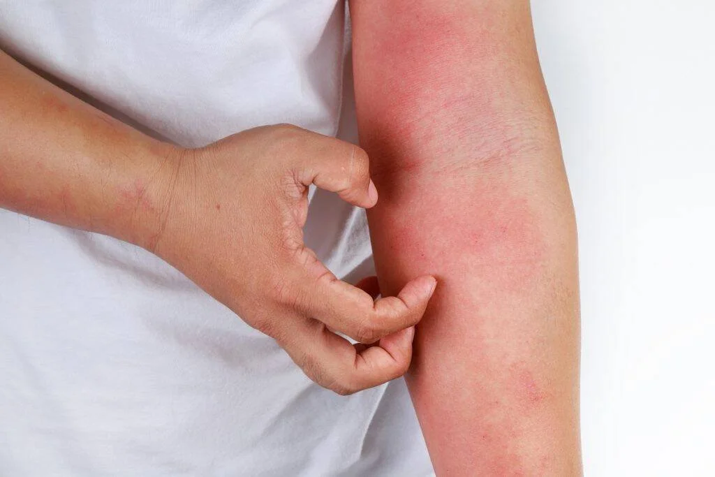 Mano rascando un brazo con enrojecimiento e irritación cutánea, signo de reacción alérgica o dermatitis.