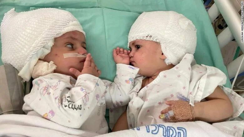 Dos bebés con vendas en la cabeza se miran tras ser separados quirúrgicamente en el Centro Médico Soroka.