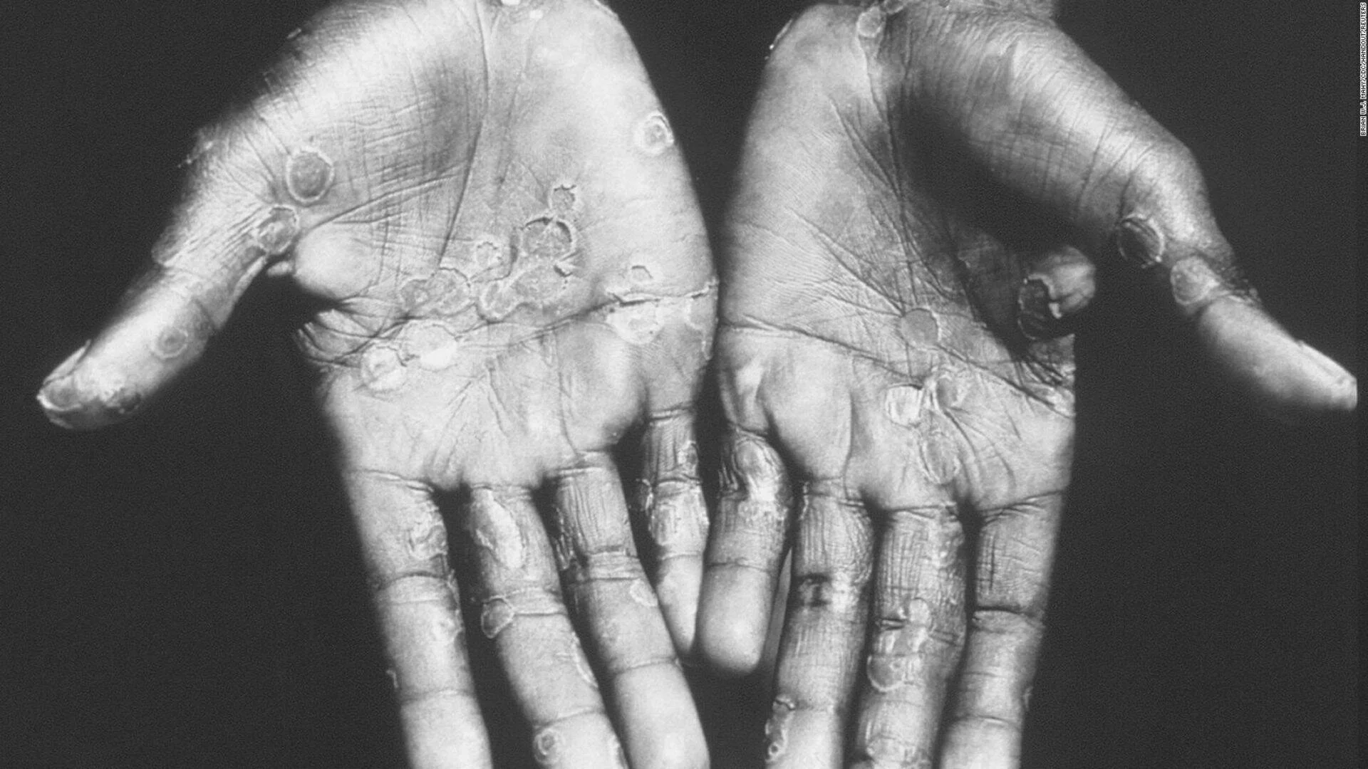 Palmas de dos manos mostrando múltiples lesiones circulares características de la viruela del mono (mpox).