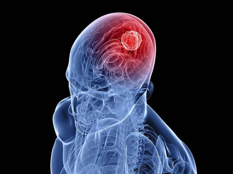 Ilustración médica en rayos X que muestra un tumor cerebral resaltado en rojo dentro del cráneo de una figura humana.