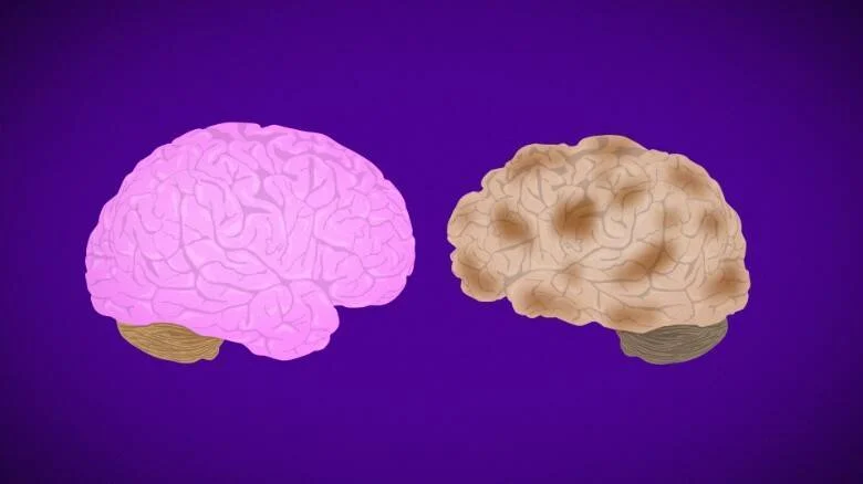 Ilustración de dos cerebros: uno rosa y saludable a la izquierda, y uno beige con manchas oscuras que indica deterioro a la derecha.