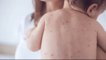 Bebé con múltiples erupciones rojizas en la espalda, sostenido por un adulto.