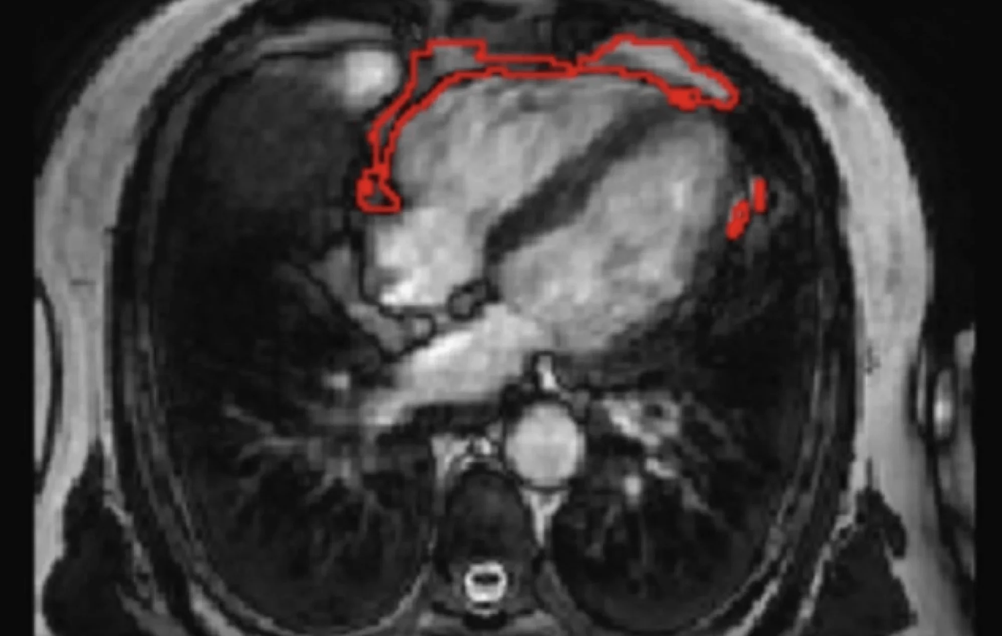 Corte coronal de resonancia magnética abdominal que muestra una gran masa hepática con contornos tumorales delimitados en rojo.