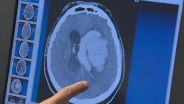 Una persona señala con el dedo una tomografía computada que muestra una lesión cerebral de gran tamaño.