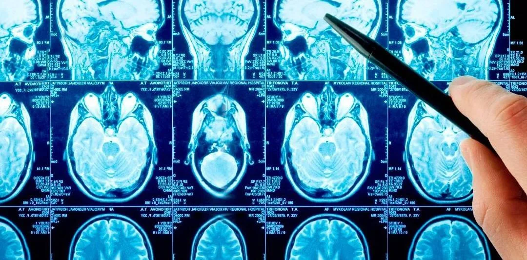 Una mano con bolígrafo señala imágenes de resonancia magnética que muestran múltiples cortes axiales del cerebro.