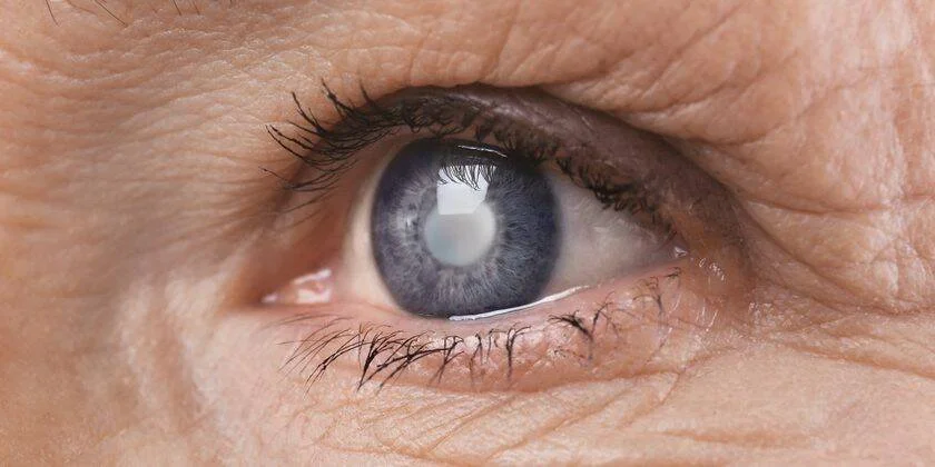Ojo de una persona mayor con opacidad en la pupila característica de una catarata, rodeado de piel con arrugas.